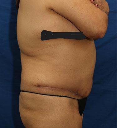 After Results for Tummy Tuck