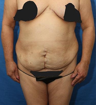 Before Results for Tummy Tuck