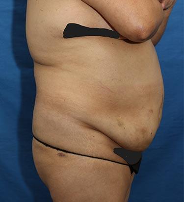 Before Results for Tummy Tuck