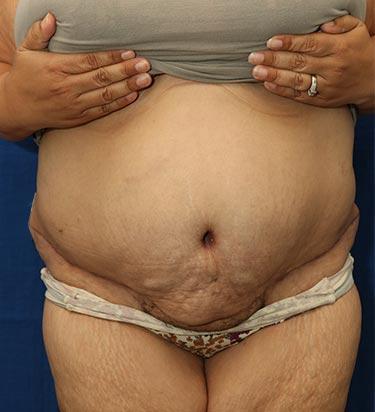 After Results for Panniculectomy