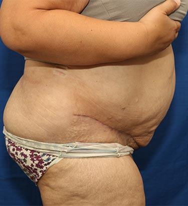 After Results for Panniculectomy