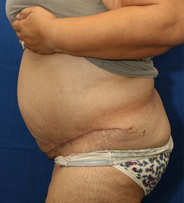 After Results for Panniculectomy