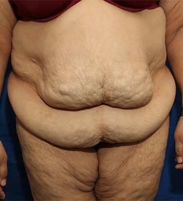 Before Results for Panniculectomy
