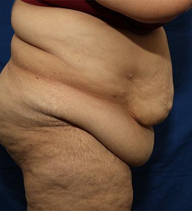 Before Results for Panniculectomy