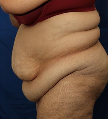 Before Results for Panniculectomy