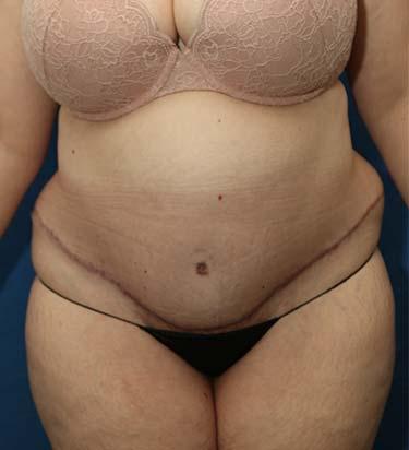 After Results for Panniculectomy