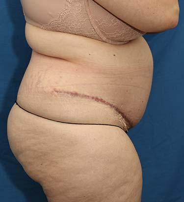 After Results for Panniculectomy