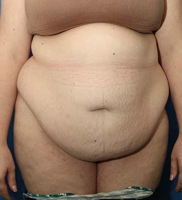 Before Results for Panniculectomy