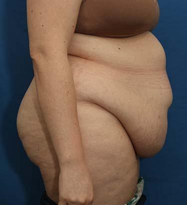 Before Results for Panniculectomy