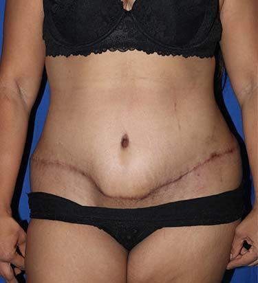 After Results for Tummy Tuck