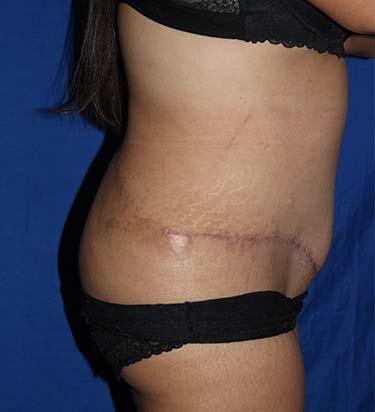 After Results for Tummy Tuck