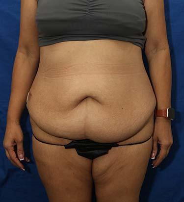 Before Results for Tummy Tuck