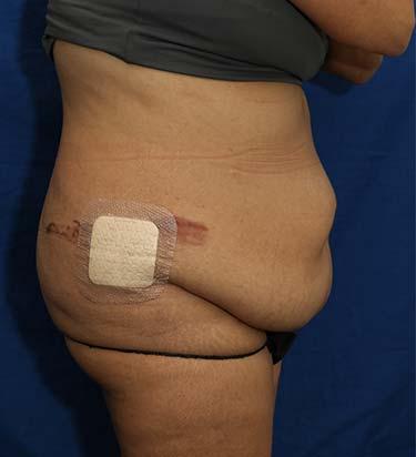 Before Results for Tummy Tuck