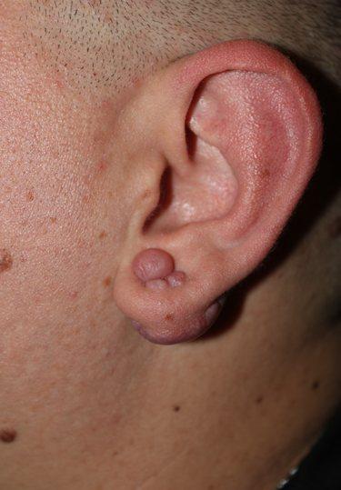 Before Results for Scar Revision