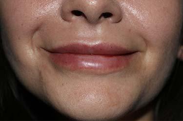 After Results for Tissue Fillers, Lip Augmentation