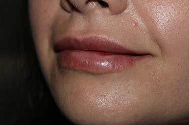 After Results for Tissue Fillers, Lip Augmentation