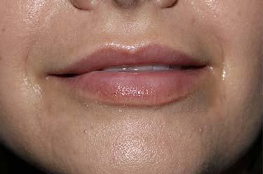 Before Results for Tissue Fillers, Lip Augmentation