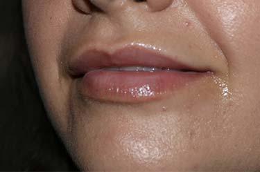 Before Results for Tissue Fillers, Lip Augmentation