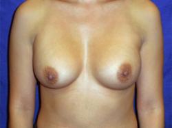 After Results for Breast Augmentation