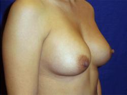 After Results for Breast Augmentation