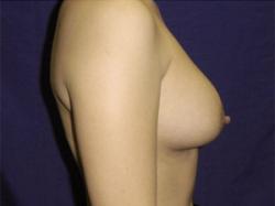 After Results for Breast Augmentation