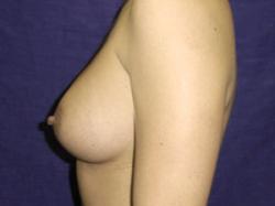 After Results for Breast Augmentation