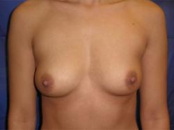 Before Results for Breast Augmentation