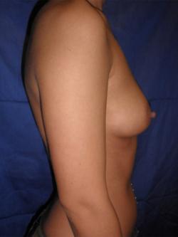 Before Results for Breast Augmentation