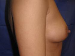 Before Results for Breast Augmentation