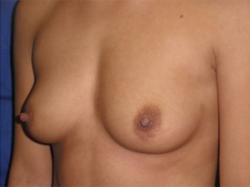 Before Results for Breast Augmentation