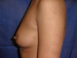 Before Results for Breast Augmentation