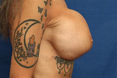 After Results for Breast Lift / Mastopexy, Implant Exchange and Removal