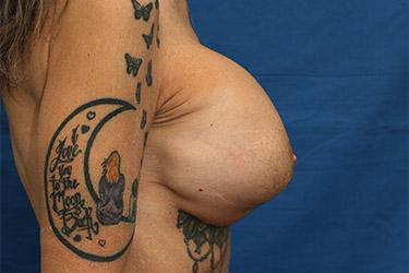 Before Results for Breast Lift / Mastopexy, Implant Exchange and Removal