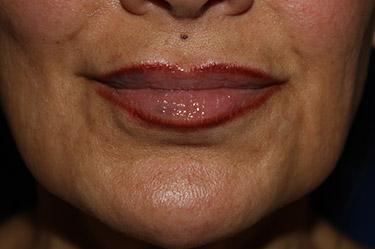 After Results for Tissue Fillers, Lip Augmentation