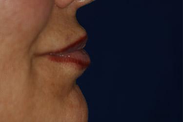 After Results for Tissue Fillers, Lip Augmentation