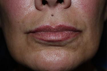 Before Results for Tissue Fillers, Lip Augmentation