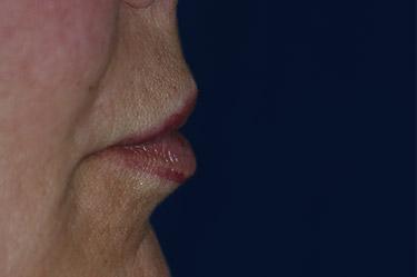 Before Results for Tissue Fillers, Lip Augmentation