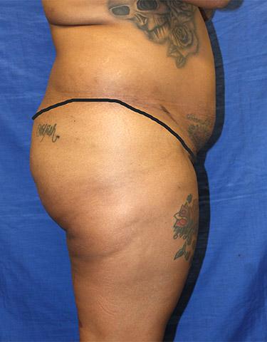 Before Results for Brazilian Butt Lift / Gluteal Augmentation