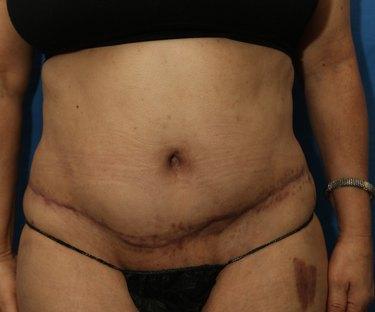 After Results for Wound Care