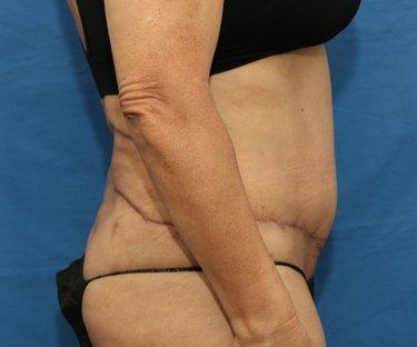After Results for Wound Care