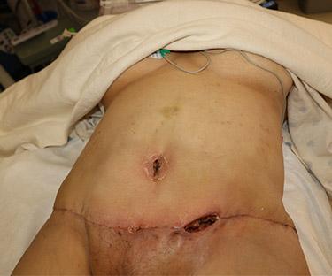 Before Results for Wound Care