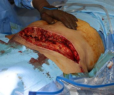 Before Results for Wound Care