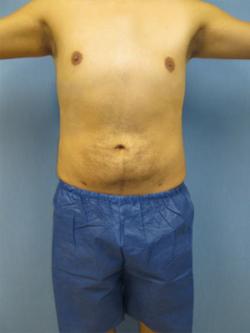 After Results for Liposuction, Gynecomastia