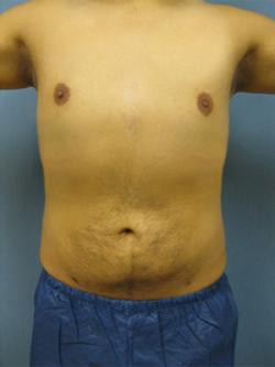 After Results for Liposuction, Gynecomastia