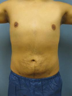 After Results for Liposuction