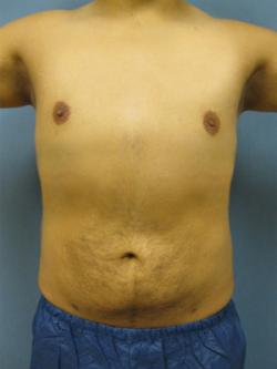 After Results for Liposuction