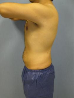 After Results for Liposuction