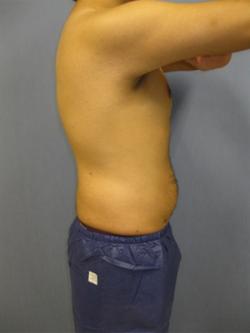 After Results for Liposuction