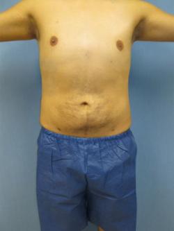 After Results for Gynecomastia