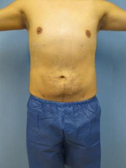 After Results for Gynecomastia